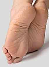 Трещины на пятках