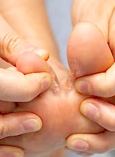 Грибок стопы