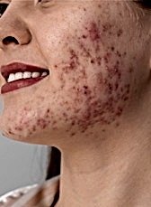 Экскориированные акне: почему нельзя давить прыщи