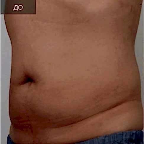 2 Ультраформер (до).jpg