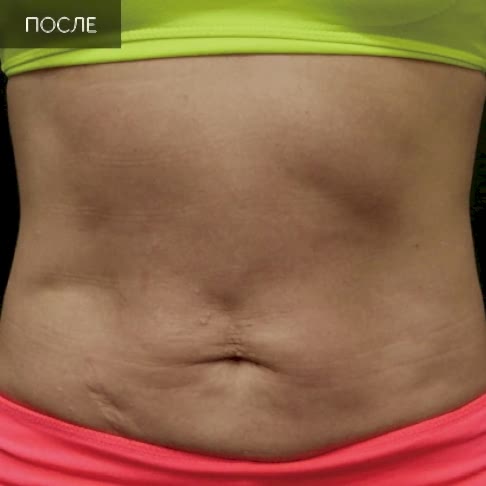 3 Ультраформер (после).jpg