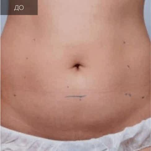 1 Ультраформер (до).jpg