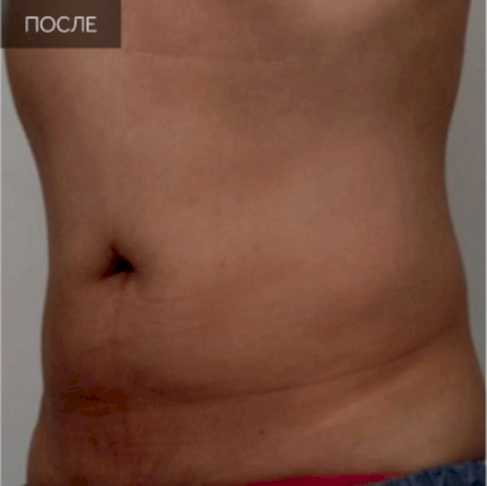 2 Ультраформер (после).jpg