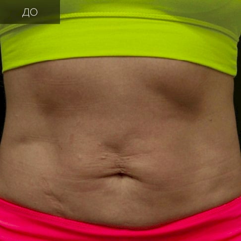 3 Ультраформер (до).jpg