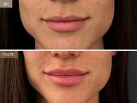 До/После фото 2 - 