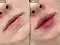 До/После фото 2 - 