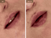 До/После фото 2 - 