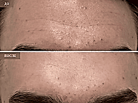 До/После фото 2 - 