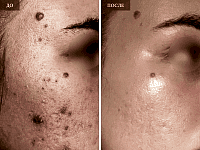 До/После фото 2 - 