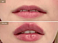 До/После фото 2 - 