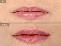 До/После фото 2 - 