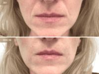 До/После фото 2 - 