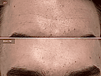 До/После фото 2 - 