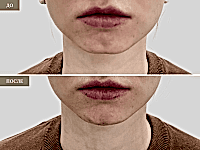 До/После фото 2 -