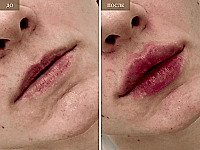 До/После фото 2 - 