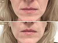 До/После фото 2 - 