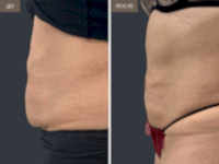 До/После фото 2 - 