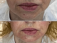 До/После фото 2 - 