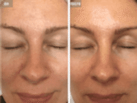 До/После фото 1 - 