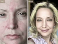 До/После фото 1 - 