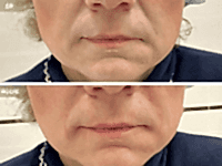 До/После фото 2 - 