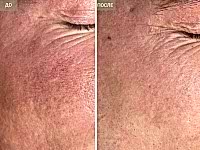 До/После фото 2 - 