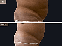 До/После фото 2 - 