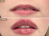 До/После фото 2 - 