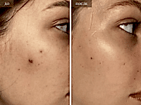 До/После фото 2 - 