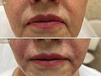 До/После фото 2 - 