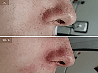 До/После фото 2 - 