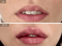 До/После фото 2 - 