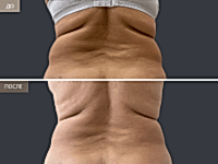 До/После фото 2 - 