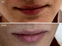 До/После фото 2 - 