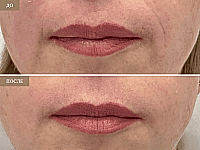 До/После фото 2 - 