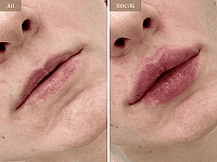 До/После фото 2 - 