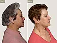 До/После фото 2 - 