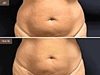 До/После фото 2 - 